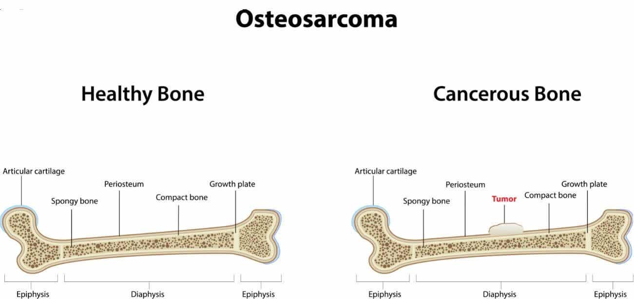ostéosarcome