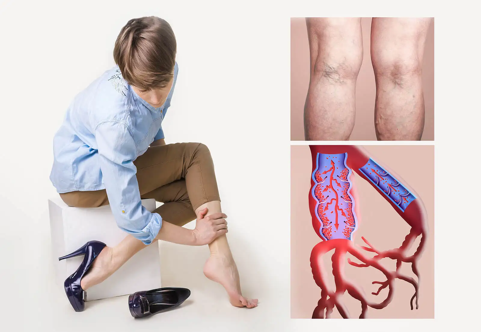 Femme avec thrombose veineuse dans les jambes.