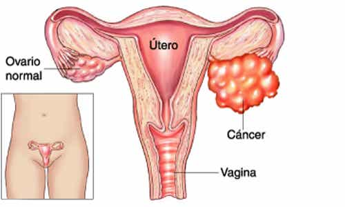 Los factores genéticos influyen en las enfermedades de los ovarios