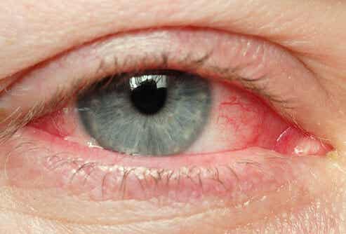 Tips naturales para los ojos irritados