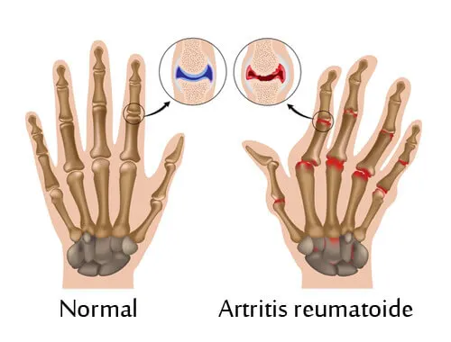 artritis reumatoide