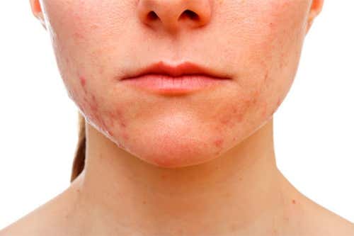 Tips para eliminar el acné que aparece en la barbilla