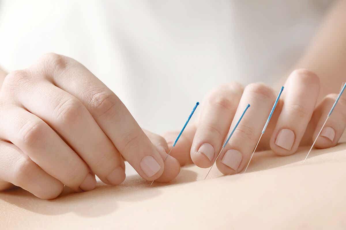 L'acupuncture en médecine intégrative.