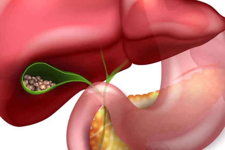 Cómo cuidar el hígado y la vesícula para evitar cálculos biliares