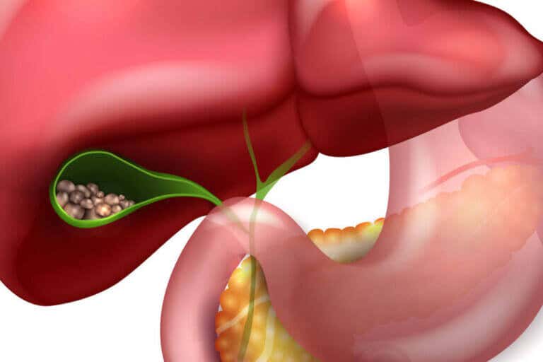 Cómo cuidar el hígado y la vesícula para evitar cálculos biliares