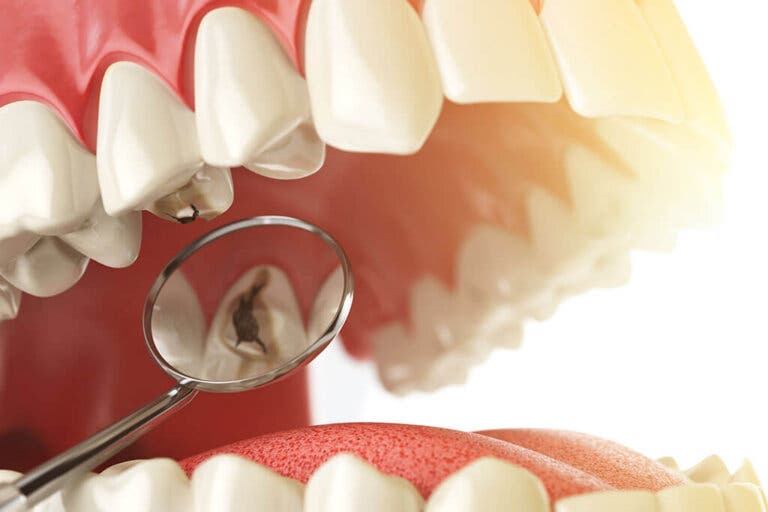 5 consejos sencillos para prevenir las caries
