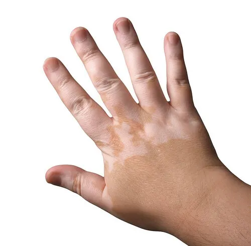 Vitiligo en las manos.