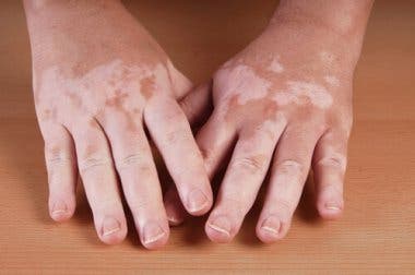 Recomendaciones naturales para mejorar el vitíligo