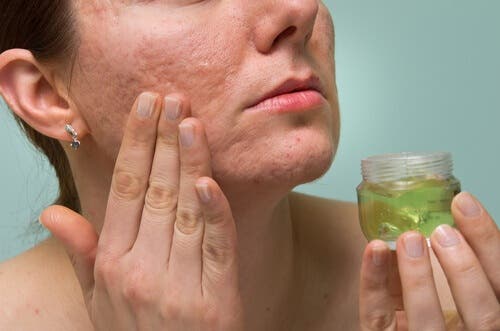 Las manchas en la piel pueden mejorar con el uso de aloe vera.