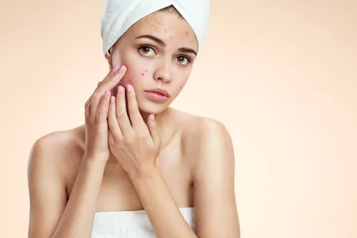 adolescente con acne