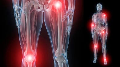 5 soluciones naturales para la rigidez en las articulaciones