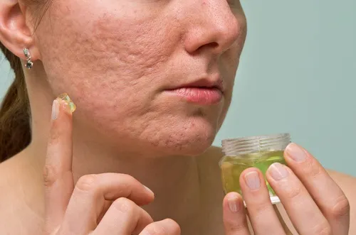 Tratamiento para el acne