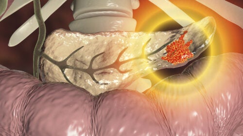 ¿Se puede prevenir el cáncer de páncreas?
