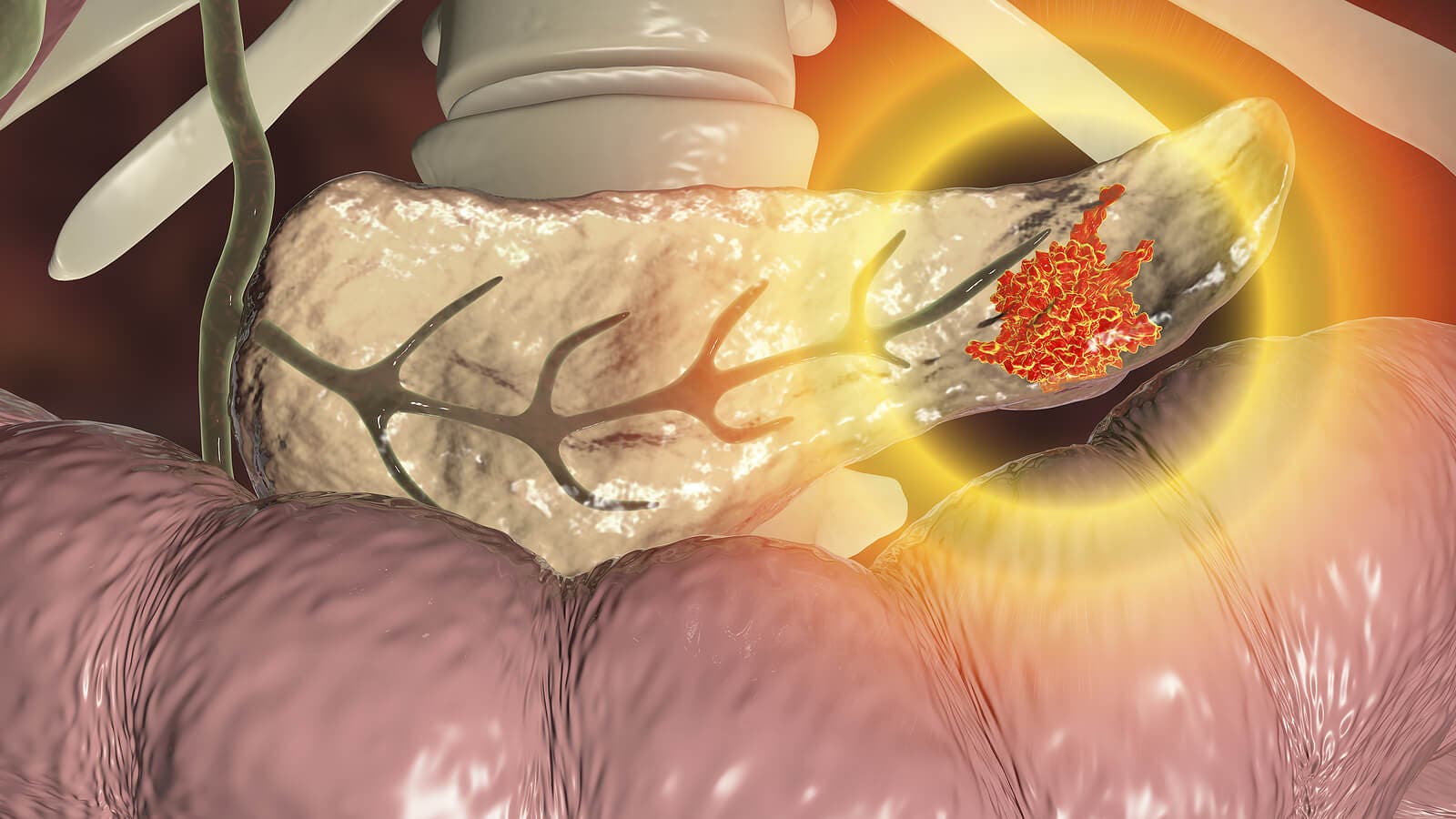 Kreft i bukspyttkjertelen.