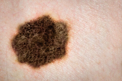 melanoma tumor negro