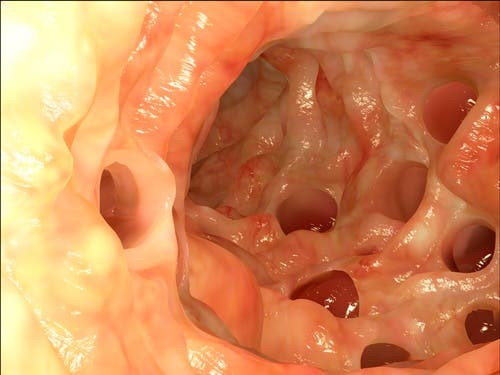 Colon con diverticulitis