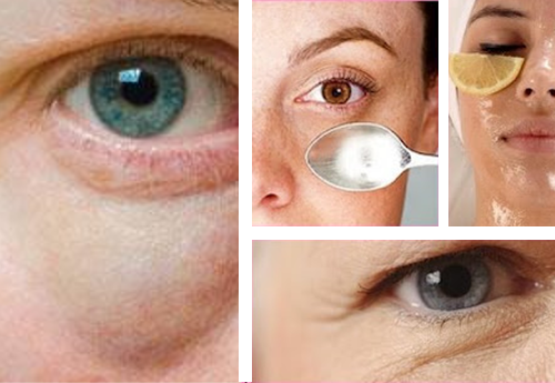 Los 5 mejores remedios caseros para atenuar las bolsas de los ojos