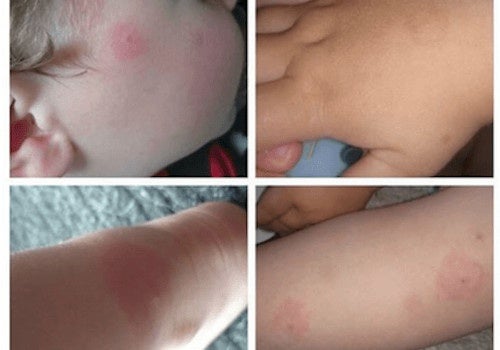 ¡Cuidado con las garrapatas! Conoce la enfermedad de Lyme y sus riesgos