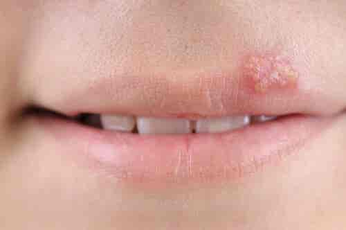 Cómo evitar o tratar el herpes oral