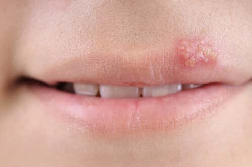 Tipos de herpes: herpes labial.