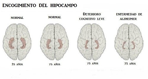 Aprende a reconocer los 10 principales indicios de la enfermedad de Alzheimer