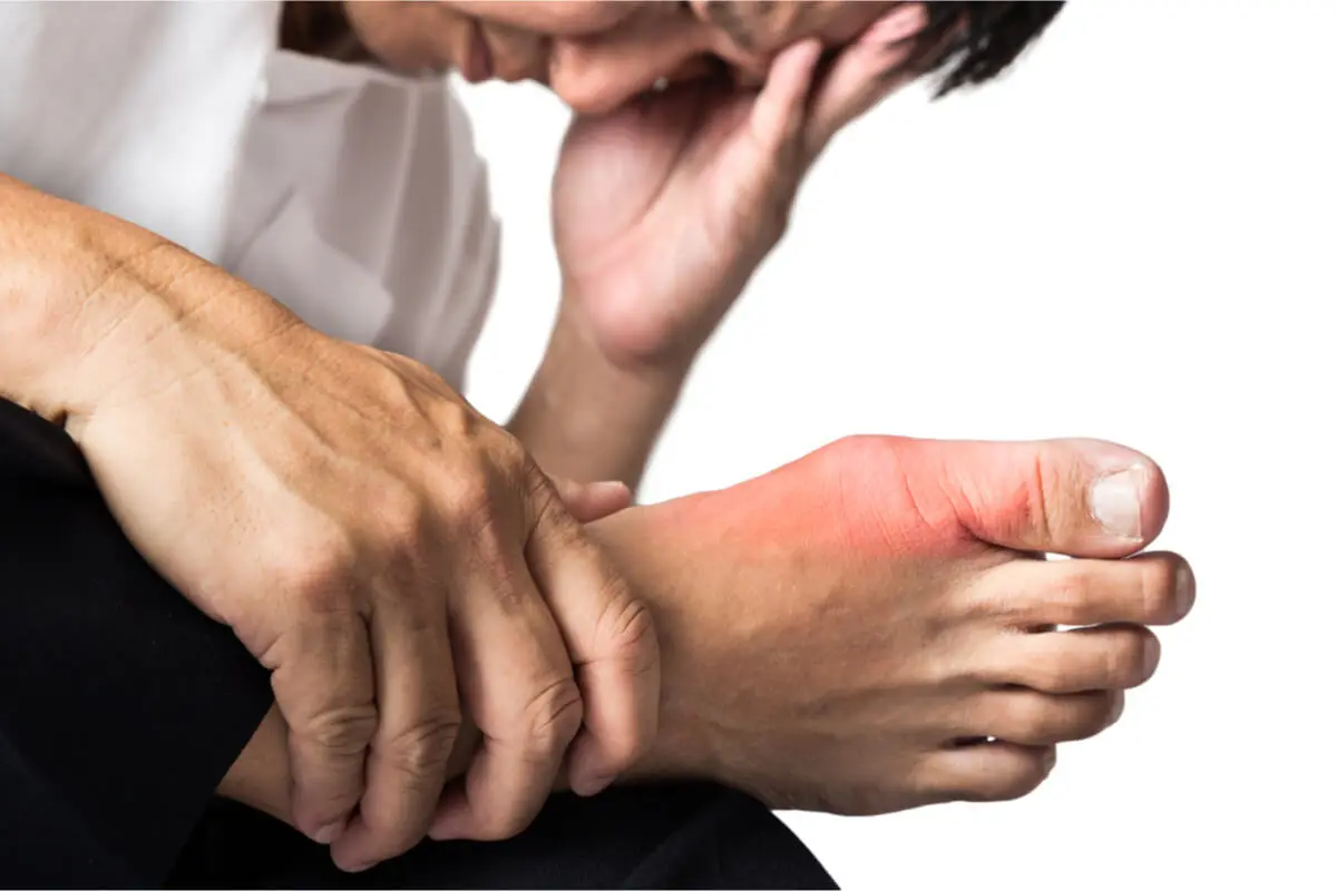 Gota causa dolor en el pie.