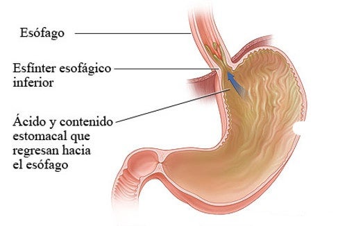 Consejos y remedios naturales para tratar el reflujo gástrico