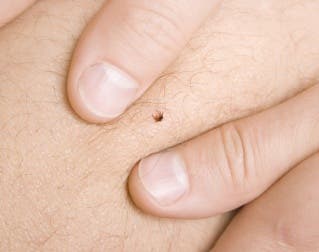 6 remedios naturales para eliminar las garrapatas de manera definitiva