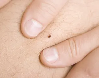 6 remedios naturales para eliminar las garrapatas de manera definitiva