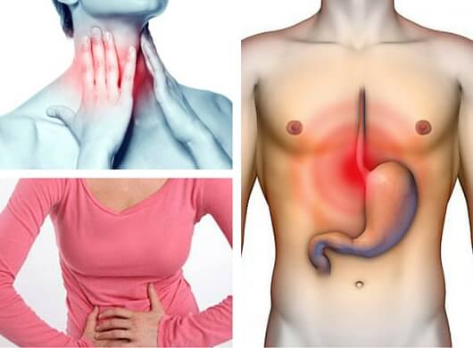 ¿Sabías que podrías sufrir reflujo gastroesofágico sin saberlo? Conoce sus síntomas y tratamientos