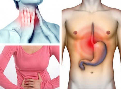 ¿Sabías que podrías sufrir reflujo gastroesofágico sin saberlo? Conoce sus síntomas y tratamientos