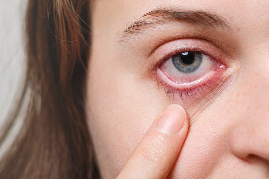 Ojos irritados