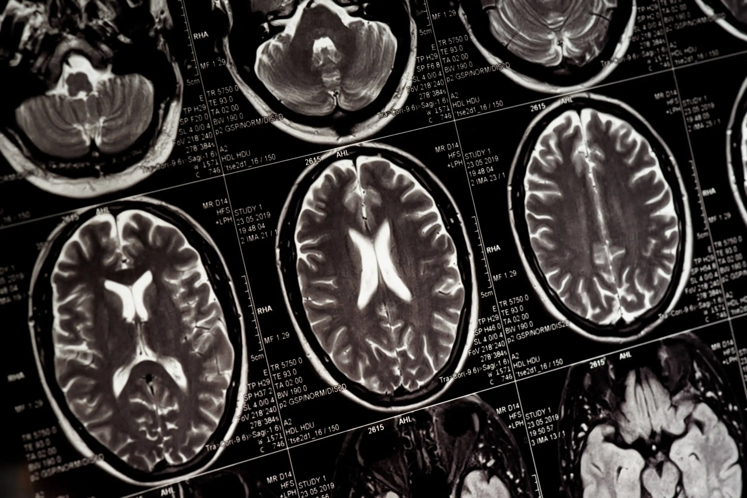 Resonancia del cerebro.