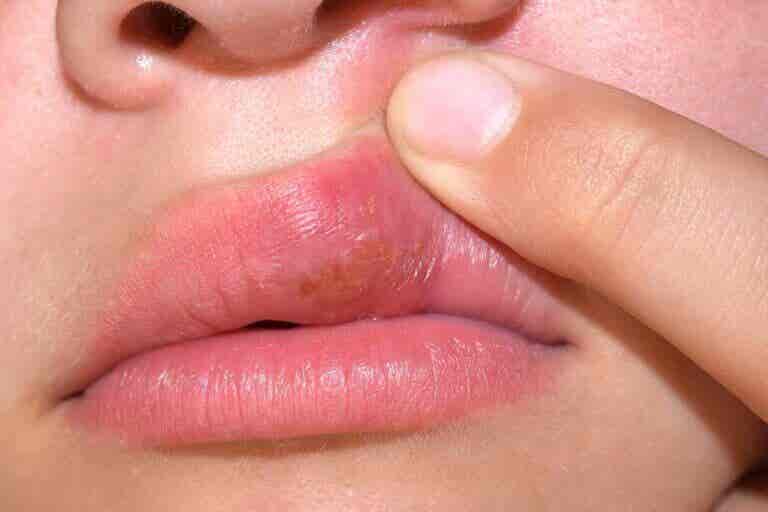 Cómo tratar aftas y úlceras bucales de manera natural