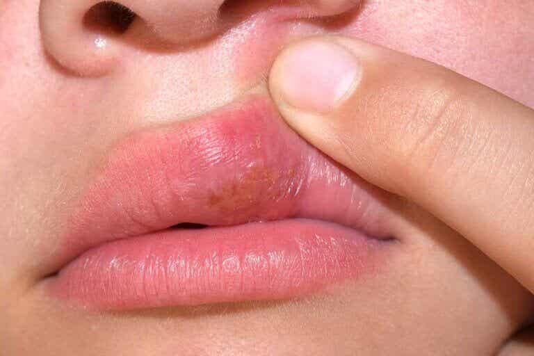 Cómo tratar aftas y úlceras bucales de manera natural