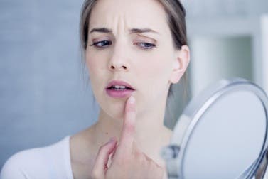 10 remedios naturales para tratar las úlceras bucales