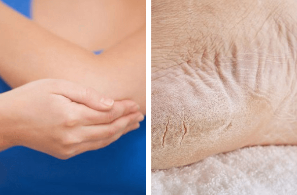 Recupera la salud de los pies y codos resecos en una semana