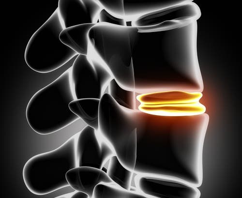 Que-es-una-hernia-discal
