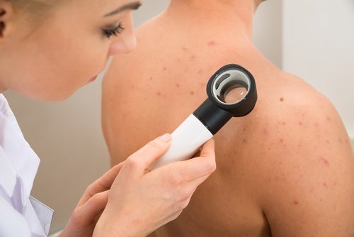 Remedios para el acné corporal (pecho, hombros y espalda)