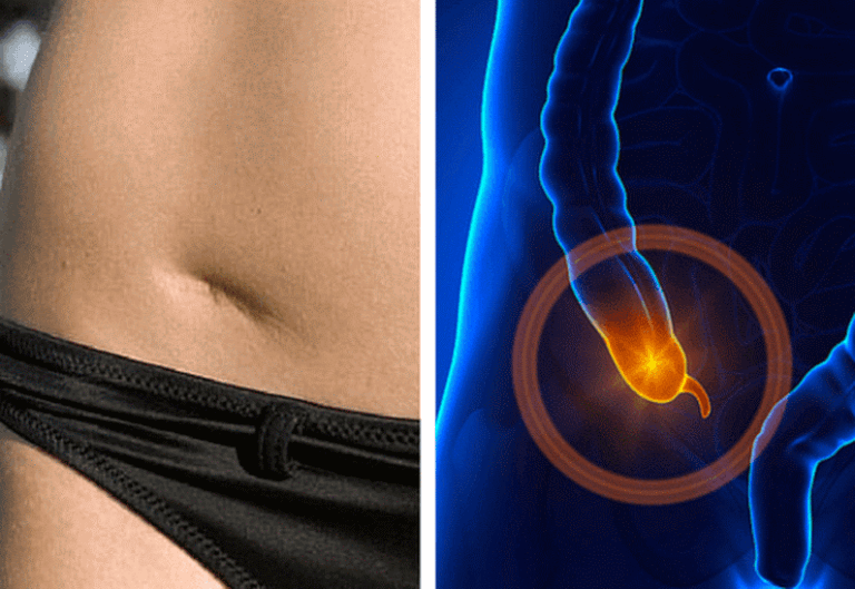 Aprende a detectar a tiempo las señales de una apendicitis