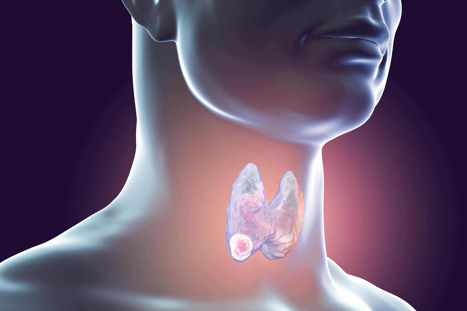 Síntomas en las mujeres que alertan un posible cáncer de tiroides