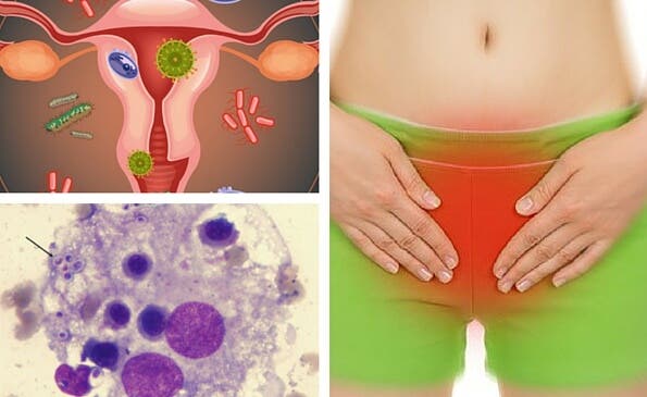 Consejos para evitar la aparición de hongos vaginales