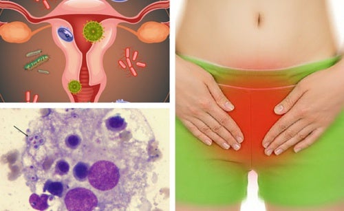 6 consejos para aliviar una infección vaginal por hongos