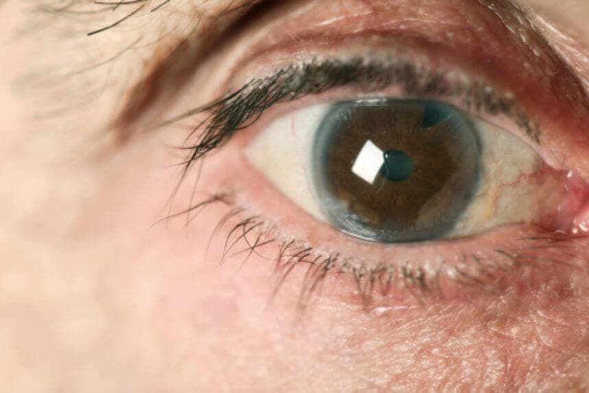 Glaucoma