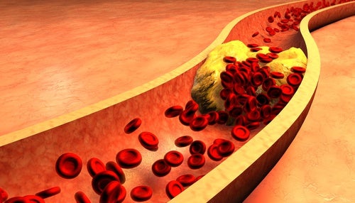 Una bacteria podría relacionar las enfermedades cardiovasculares con las de encías