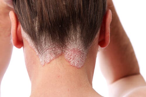 Aspectos previos al teñir un cabello con psoriasis