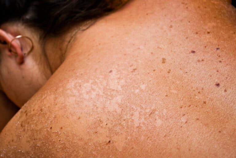 6 buenos remedios naturales para aliviar las quemaduras solares