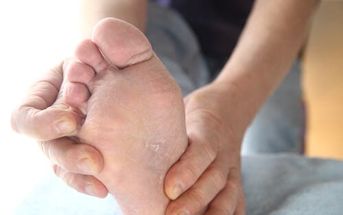 Remedios para tratar naturalmente el pie de atleta