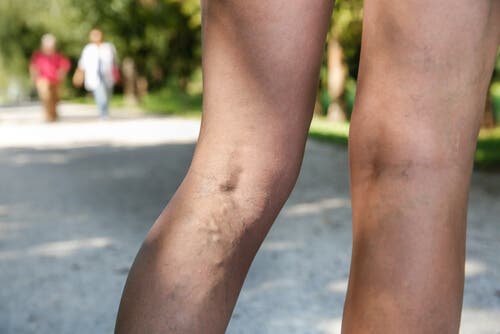 Piernas con várices