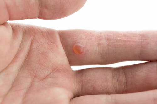 7 ingredientes que tienes en tu casa para combatir las verrugas